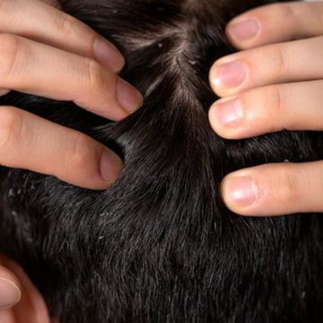 8 conseils pour se débarrasser des pellicules.