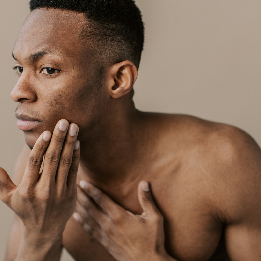 L'acné hormonale masculine : nos explications et conseils