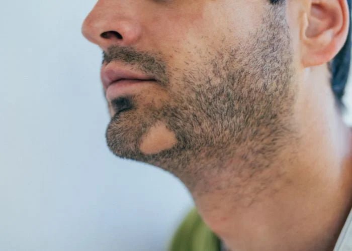 Trous dans la barbe (et imperfections) : top 5 des erreurs commises par les hommes